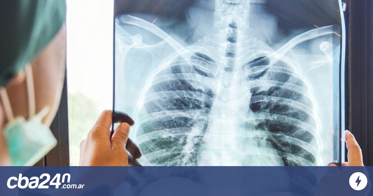 Tuberculosis en Córdoba qué hacer y a dónde acudir en caso de contagio